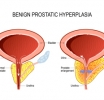 Aquablation Studied as Enlarged Prostate Treatment